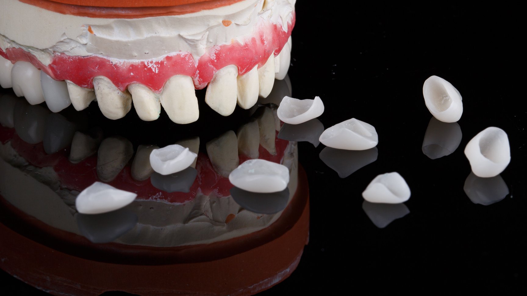 dental veneers and ceramic crowns plaster model for trying on